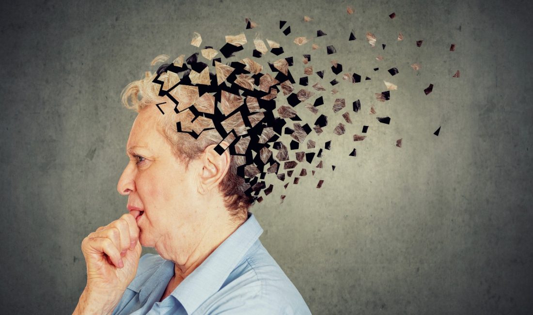 Alzheimer hastalığı, beynin küçülmesine