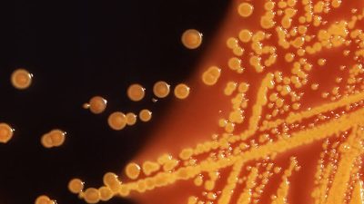 Vücudunun ürettiği alkol nedeniyle çeşitli rahatsızlıklar yaşayan Verda Güniz Atis