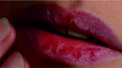 Dudak çatlaması; dudakların yüzeylerinde gözle görülür şekilde çatlaklar, yarıklar oluşması, bazen