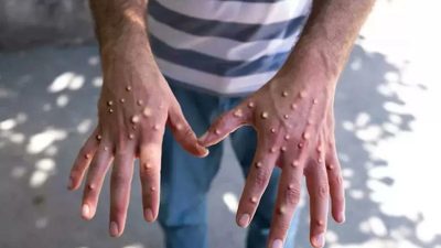 Sağlık Bakanı Kemal Memişoğlu, maymun çiçeği (M çiçeği) ve Covid-19