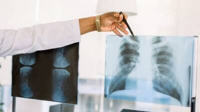 Giresun Sendromu, nadir bir hastalık olarak sağlık dünyasında dikkat çekiyor.