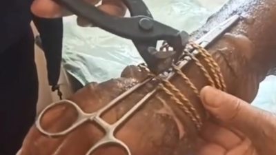 Yayladağı ilçesinde bir kadının kolunda meydana gelen yanık, acil tıbbi