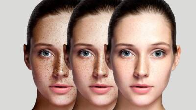 – Medipol Mega Üniversite Hastanesi Dermatoloji Uzmanı Prof. Dr. Ali