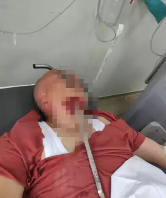 Hatay’da Kan Donduran Kaza: Yüzüne Demir Saplandı Hatay’ın İskenderun ilçesinde yaşanan iş kazasında, bir inşaat işçisinin yüzüne