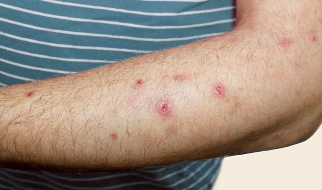 Sedef, egzama, vitiligo ve saçkıran gibi kronik cilt hastalıklarının tedavisinde