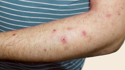 Sedef, egzama, vitiligo ve saçkıran gibi kronik cilt hastalıklarının tedavisinde